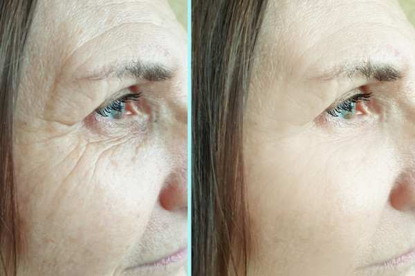 Why Do People Choose HIFU for a Non-Surgical Facelift? 4 How long can HIFU results last Paisley?