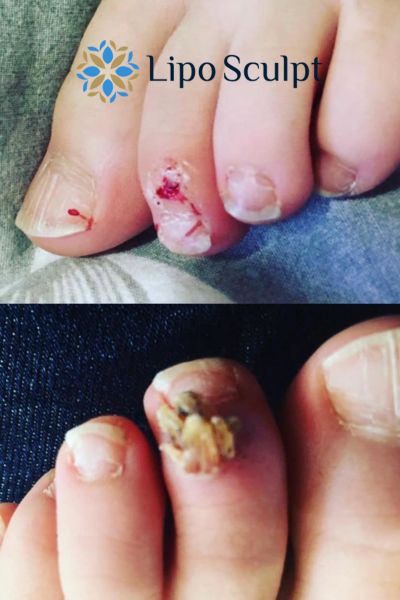 Wart removal customer results from Lipo Sculpt Paisley